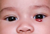 U máu vùng hàm mặt ở trẻ có cần điều trị