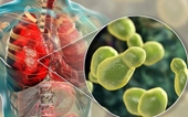 Các nhiễm trùng hô hấp thường gặp ở người nhiễm HIV