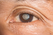 4 bệnh về mắt hay gặp ở người tiểu đường