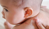 Viêm da cơ địa ở trẻ em dễ tái phát, biện pháp chăm sóc da đúng cách