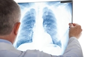 4 biểu hiện cảnh báo sớm ung thư phổi ở nam giới
