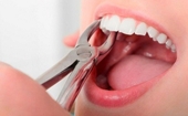 Những nhận định sai lầm khi nhổ răng