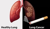 Chồng hút thuốc lá vợ lại mắc ung thư phổi, chuyên gia ung thư nói gì