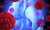 Nấm phổi Nguyên nhân, triệu chứng và cách điều trị hiệu quả