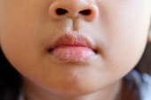 Cha mẹ hãy chú ý tới việc con cái hay liếm môi, có thể trẻ mắc căn bệnh này