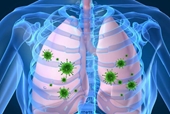 Viêm phổi ở trẻ có triệu chứng gì
