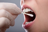 Israel Trị liệu quang sinh học giúp giảm hội chứng bỏng rát miệng
