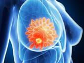 Nghiên cứu mới hé mở hy vọng ngăn chặn ung thư vú tái phát