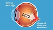 Thực phẩm tốt cho mắt và phòng ngừa tăng nhãn áp