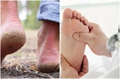 4 triệu chứng thường gặp ở bàn chân khi bạn già đi