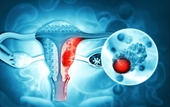 4 loại ung thư thường gặp ở phụ nữ và cách phát hiện sớm