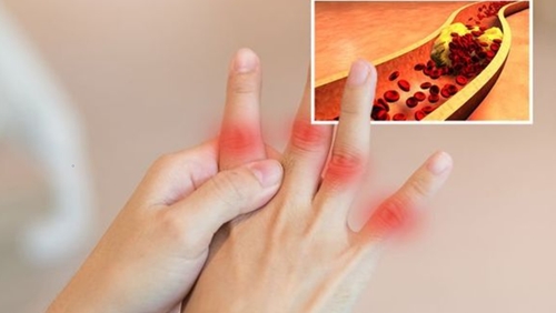 7 dấu hiệu bất thường báo hiệu cholesterol cao ở nam giới phát ra ở bàn tay