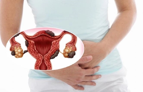 Lạc nội mạc tử cung có triệu chứng gì
