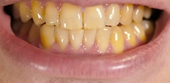 Răng ố vàng có phải là bệnh