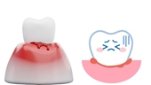 5 cách giúp cải thiện tình trạng chảy máu chân răng