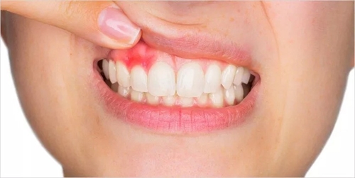 Lười đánh răng có thể làm tăng nguy cơ ung thư