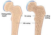 Người bị loãng xương tập gì, kiêng tập gì