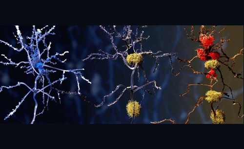 Phát hiện thủ phạm tiềm năng mới của bệnh Alzheimer