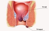 3 biến chứng của bệnh trĩ cần biết