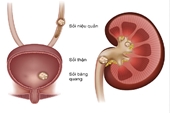 Sỏi tiết niệu Nguyên nhân, triệu chứng, cách điều trị và phòng bệnh