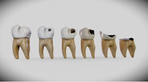 Sâu răng Nguyên nhân, triệu chứng, điều trị và cách phòng ngừa