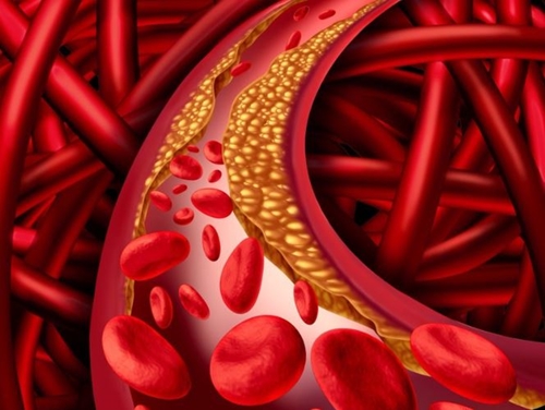 Rối loạn lipid máu có chữa khỏi được không
