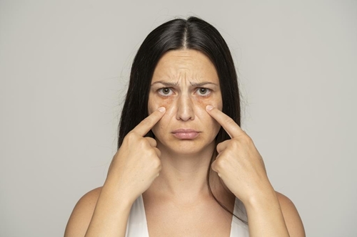 5 mẹo giảm thâm mắt hiệu quả nhanh