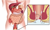 Bệnh trĩ nội hay trĩ ngoại nguy hiểm