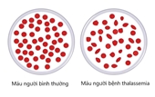 Vì sao cần xét nghiệm gen Thalassemia