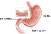 Viêm loét dạ dày có thành ung thư không