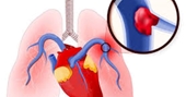5 cách đơn giản để kiểm soát bệnh tăng huyết áp phổi