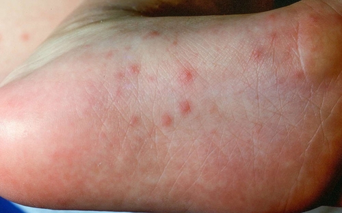 7 bệnh gây phát ban, mẩn ngứa da do virus cần lưu ý trong mùa hè