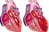 Suy tim trái Nguyên nhân, triệu chứng, cách điều trị và phòng bệnh