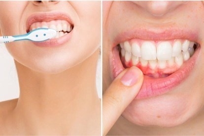 Vì sao bạn không nên đánh răng ngay sau khi bị nôn mửa