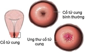 Người bệnh ung thư tử cung nên vận động như thế nào