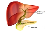 Biến chứng nguy hiểm của sỏi đường mật trong gan