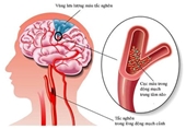 Những thói quen xấu khiến bạn dễ bị đột quỵ