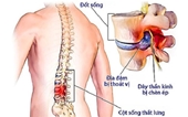 5 lý do gây thoát vị đĩa đệm ai cũng nên biết