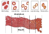 Loạn sản cổ tử cung Nguyên nhân, triệu chứng, cách điều trị và phòng ngừa