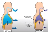 Bài tập cho người mắc hội chứng Lyell