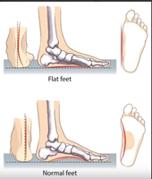 Câu hỏi thường gặp liên quan đến bàn chân bẹt