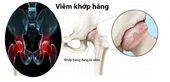 Trẻ sưng đau vùng háng, khó ngồi, cảnh giác với viêm khớp háng