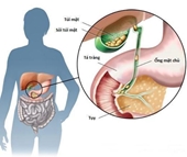 Sỏi mật khi nào cần phải mổ