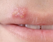 Cách phòng tránh lây nhiễm Herpes sinh dục