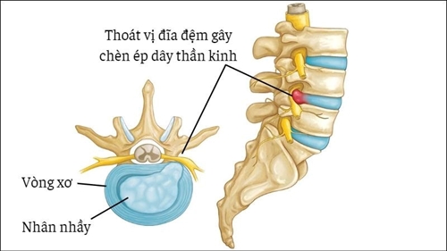 Đau lưng dưới do ngồi nhiều làm sao phòng tránh