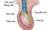 Viêm ống dẫn tinh điều trị như thế nào